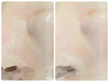 トータルビューティ ノイド(Noid)/毛穴洗浄　全顔フル