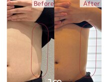 脱毛 痩身ぴゅあら/気になる部位をすっきり！！