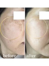 エステサロンパリス(Esthe Salon Paris)/レーザーでなくても薄く！