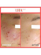 エステ＆リラク 宮/ 毛穴ララピール：BeforeAfter