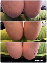 角質フットケア