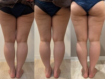 モリタ鍼灸整骨院/ラジオ波下半身コース