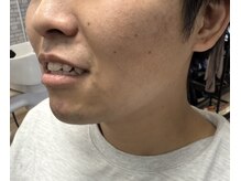 6回でここまで！！メンズ脱毛も人気です！#メンズ脱毛#ひげ脱毛