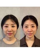 ココロ美容整体院(cocoro)/小顔調整 BeforeAfter