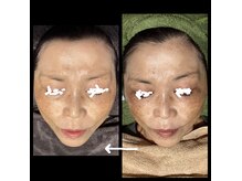 ココスタイルビューティー(COCOSTYLE beauty)の雰囲気（光フェイシャル、ララピールのWケア!10回以上）