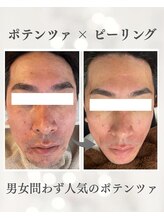 リノ ショウナン(LINO SHONAN)/ポテンツァ×ハーブピーリング