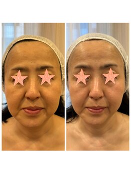 マックス(MAX)/たるみ改善/リフトアップ効果