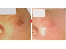 サロンドエステケイワイ(de KY)/フェイシャル☆濃いシシミ改善