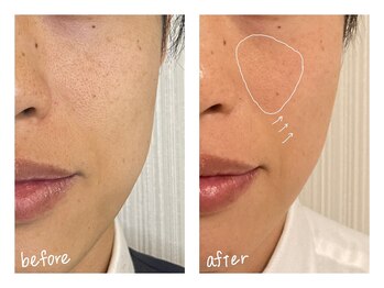 ミースプラス(me,as+)/高周波サーマ 全顔1回 (術後2w)