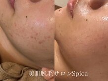 スピカ(SPICA)/ニキビでお悩みの方におすすめ