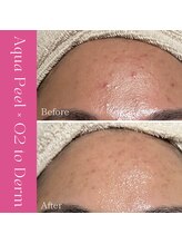 ハナイロ(hana-iro)/アクアピール×白玉酸素セラピー