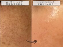 育肌美研 自由が丘サロン/シミケア｜ハーブピーリング