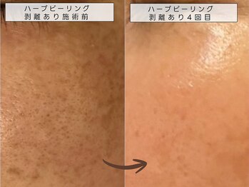 育肌美研 自由が丘サロン/シミケア|ハーブピーリング