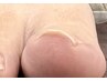 【Foot 巻き爪ケア】オフのみ　※端正した指のみ