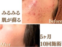 アクール(Accueil)