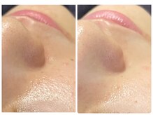 トータルビューティ ノイド(Noid)/毛穴洗浄　全顔フル