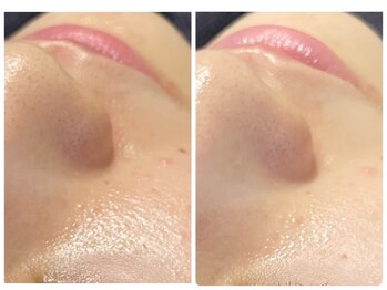 トータルビューティ ノイド(Noid)/毛穴洗浄　全顔フル