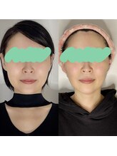 ピュアプラス(Pure Plus)/レモンボトルモニター様