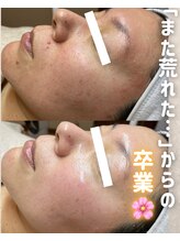 ウニカ(Unica)/赤み/ニキビ/年齢肌