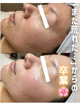 ウニカ(Unica)/赤み/ニキビ/年齢肌