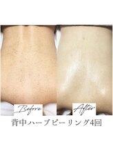 ビズビズ 梅田店(bisebise)/〈症例〉毛孔性苔癬/ニキビ/跡