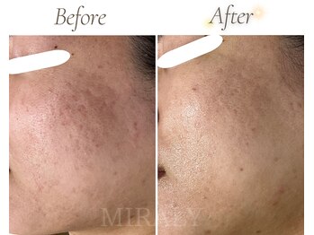 ミラリー(MIRALY)/肌荒れ跡・赤みケア 6ヶ月(30代)