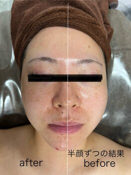 ラペ(la paix)/フェイシャル症例写真/30代