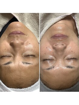 エステティックサロン S/ビフォーアフター