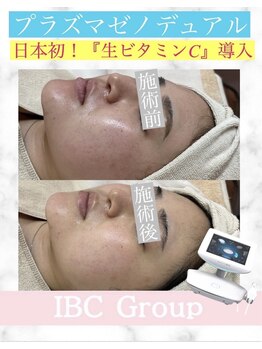 トータルサロンアイビーシー(トータルサロンIBC)/プラズマ+日本初!生ビタミンC