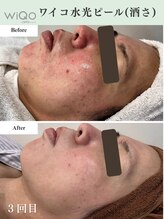 ソーヴ(SOLVE)/酒さのお悩み改善例/ピーリング