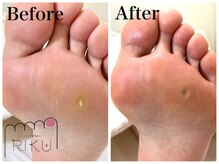 りく/角質ケア45分+魚の目ケア