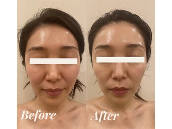 シェリール(Cherir)/小顔矯正