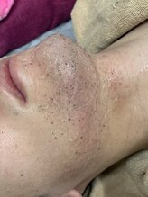 エピラージュ 町田店/施術中抜けたヒゲたち