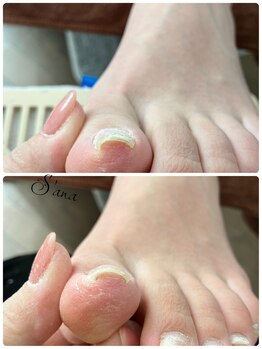 サナ 久が原 千鳥町(S’ana)/巻き爪今日