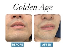 ゴールデンエイジ(Golden Age)/【ヒゲ脱毛】Before＆After
