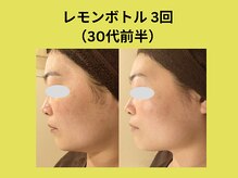 アユアラングレース/レモンボトル3回