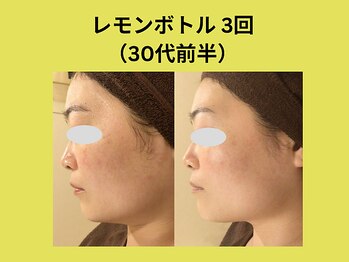 アユアラングレース/レモンボトル3回