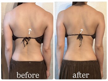 ビノスビューティー(vinos.beauty)/症例写真　上半身痩身