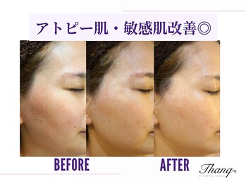 サンク(Thanq)/敏感肌のエイジングケア