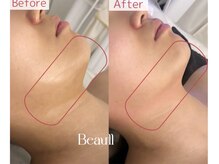 脱毛 痩身ぴゅあら/二重アゴすっきり！！