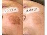 【40.50代人気】シミくすみ年齢肌 大人の集中美白肌管理