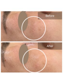 ハニー(Honey)/毛穴気なる方へ