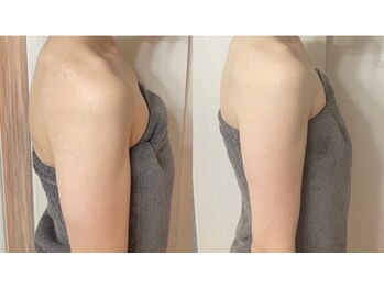 ヨサパーク リアン(YOSA PARK Lien)/モニター様before→after/痩身