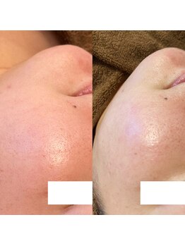 ひっそり美肌構築/ハーブピーリングで美肌へ♪