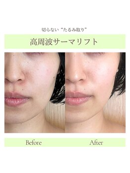 ラジェム(LA GEMME)/切らないフェイスリフト