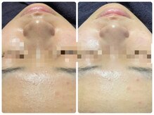 トータルビューティ ノイド(Noid)/毛穴洗浄　全顔フル