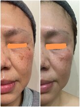 シャンティ 三郷店(Beauty Works Shanti)/お客様の成果☆（5）