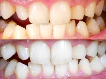 ホワイティア 東金店(WHITEA)/8回照射