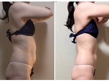 ツボミ(TSUBOMI)/モニター様　before・after