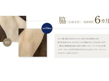 サロン ニヒル(SALON NIHIL)/◇女性ワキ脱毛◇